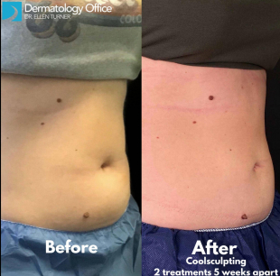CoolSculpting<sup>®</sup> Before and After Case 14 