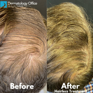 Exoflo-Hair Restoration Before and After Case 2 