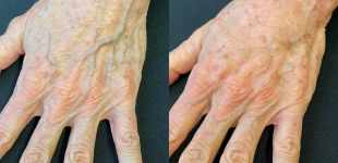 Radiesse Hands (2 Syringes) Before and After Case 8 