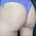 Radiesse Before and After Case 5 After