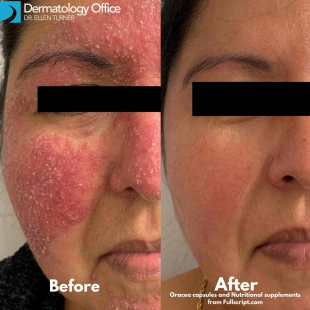 Rosacea Before and After Case 2 