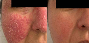 Atopic Dermatitis Before and After Case 1 