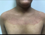 Eczema Before and After Case 7 Before