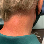 SRT-100  Radiation Before and After Case 12 After