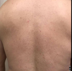 Psoriasis Before and After Case 12 After