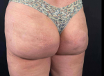Radiesse Butt Augmentation Case 3 After