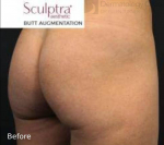 Sculptra (10 Vials) Before and After Case 2 Before
