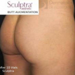 Sculptra (10 Vials) Before and After Case 2 After