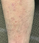 Psoriasis Before and After Case 17 Before