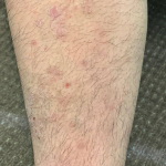Psoriasis Before and After Case 17 Before