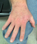 Psoriasis Before and After Case 20 Before