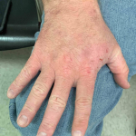 Psoriasis Before and After Case 20 Before