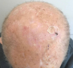 SRT-100  Radiation Before and After Case 25 After