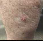 Sensus Radiation Therapy Before and After Case 26 Before