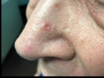 SRT-100  Radiation Before and After Case 28 Before