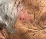 SRT-100 Radiation Before and After Case 39 Before