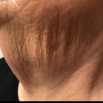 SRT-100 Radiation Before and After Case 41 After