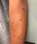 Psoriasis Before and After Case 22 Before