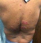 Psoriasis Before and After Case 24 Before