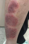 Psoriasis Before and After Case 26 Before