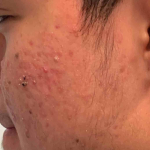 Acne Before and After Case 10 Before
