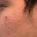 Acne Before and After Case 10 After