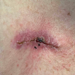 Skin Cancer Before and After Case 9 After