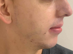 Acne Before and After Case 11 Before