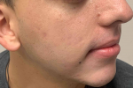 Acne Before and After Case 11 After