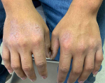 Allergic Contact Dermatitis Before and After Case 4 Before