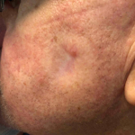 SRT-100 Radiation Before and After  Case 47 After