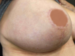SRT-100 Radiation Before and After Case 51 After