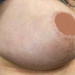 SRT-100 Radiation Before and After Case 51 After