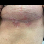 SRT-100 Radiation Before and After Case 54 After