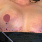 SRT-100 Radiation Before and After Case 57 After