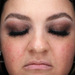 Rosacea Before and After Case 3 Before