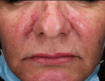 Rosacea Before and After Case 4 Before