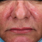 Rosacea Before and After Case 4 Before