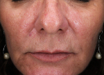 Rosacea Before and After Case 4 After
