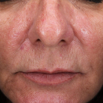 Rosacea Before and After Case 4 After