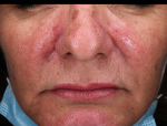 IPL-Photofacial/BBL Before and After Case 10 Before