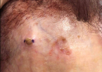 SRT-100 Radiation Before and After Case 65 Before