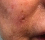 Skin Cancer Before and After Case 11 Before