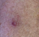 Skin Cancer Before and After Case 12 Before