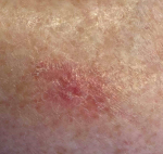 Skin Cancer Before and After Case 12 After