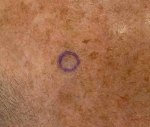 Skin Cancer Before and After Case 14 Before