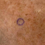 Skin Cancer Before and After Case 14 Before