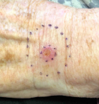 Skin Cancer Before and After Case 15 Before