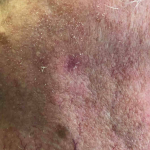 Skin Cancer Before and After Case 16 Before