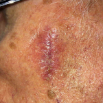 Skin Cancer Before and After Case 16 After